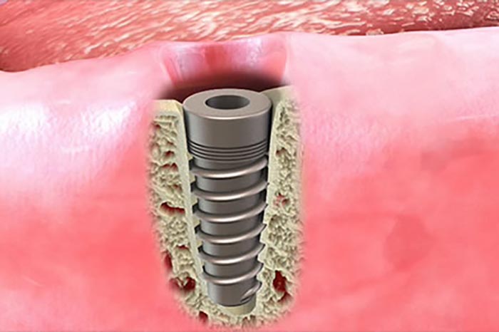 Full Arch Dental Implants