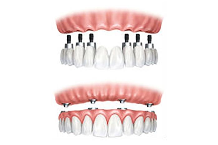 Full and Partial Dentures in San Jose, CA
