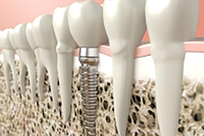 Dental implants