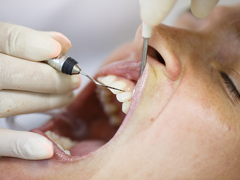 Periodontal gum disease exam with dental tools on teeth in clinic in San Jose, CA
