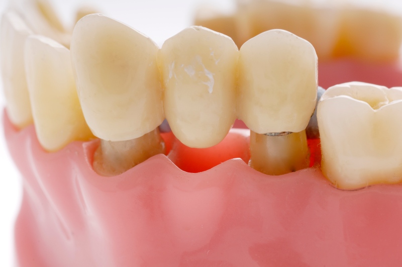 Dental bridge supported by dental implants replacing missing teeth in San Jose, CA